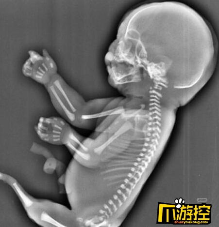 刚出生的婴儿畸形图片图片